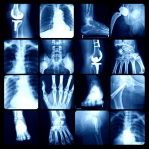 DEXA Bone Scanning - Preserving Bone Density. Importance of regular testing  | Independent Imaging